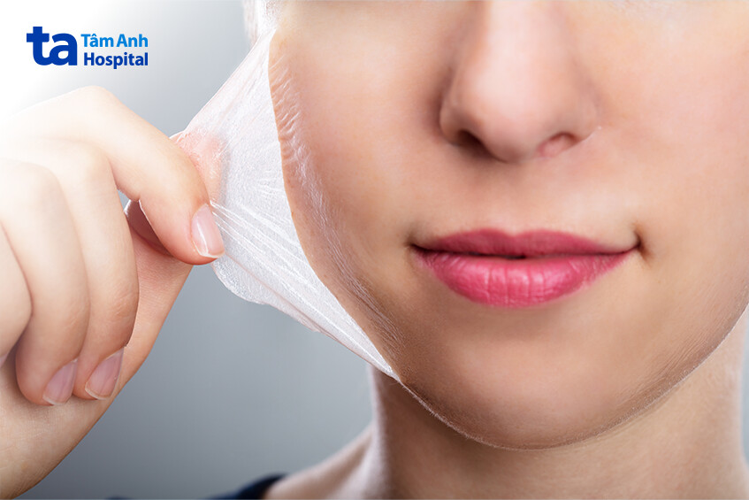 phân biệt peel da và lăn kim