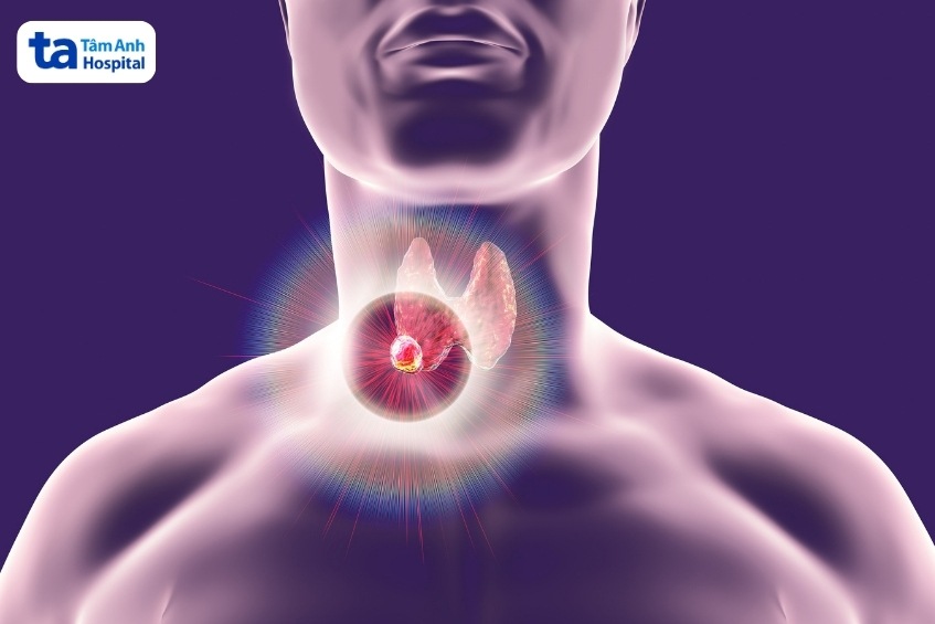phẫu thuật là phương pháp điều trị chính của ung thư tuyến giáp
