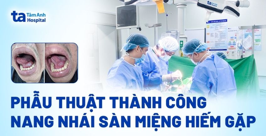 Phẫu thuật thành công nang nhái sàn miệng hiếm gặp