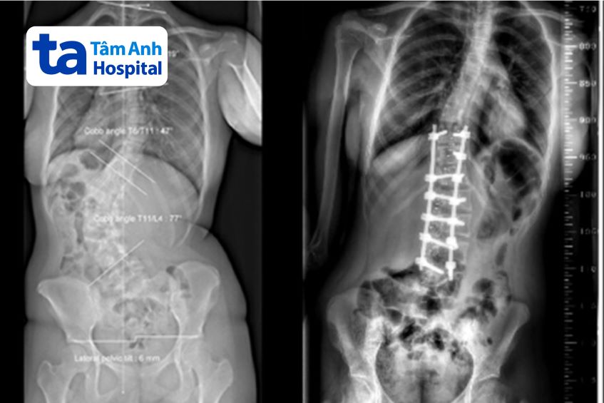 phim chụp x-quang cột sống