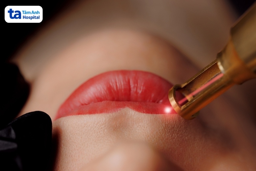 phương pháp xóa hình xăm ở môi hiện nay