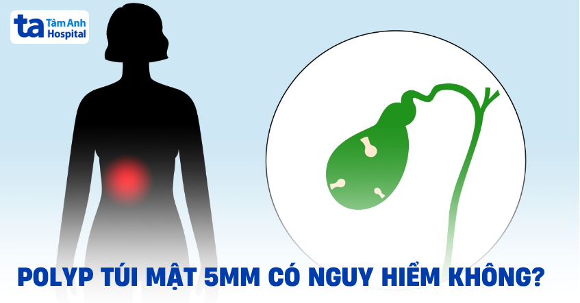 Polyp túi mật 5mm có nguy hiểm không?