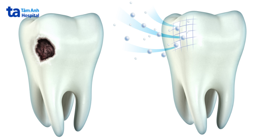 Hình ảnh so sánh răng sâu và răng được tái khoáng bằng hydroxyapatite