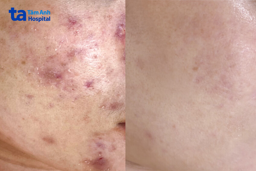 sau 1 năm kiên trì điều trị