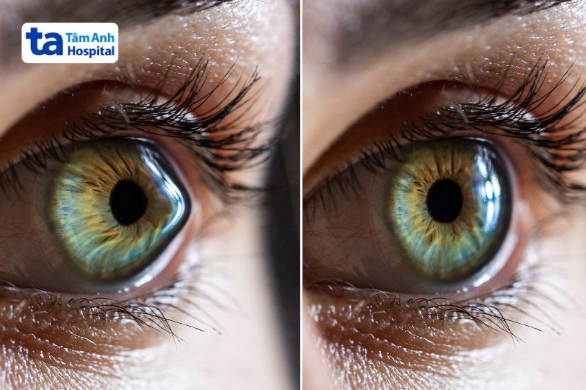 Sự khác biệt giữa giác mạc