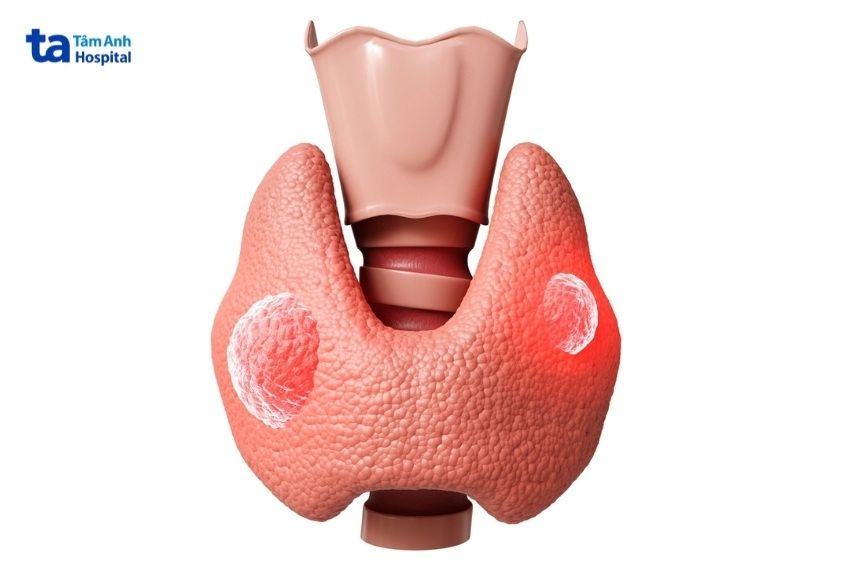 sưng cổ là dấu hiệu ung thư tuyến giáp