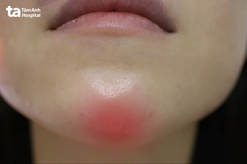 sưng đỏ nhẹ sau tiêm là bình thường