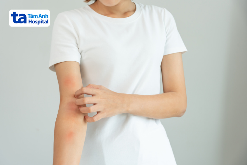 Người phụ nữ bị ngứa da tay, dấu hiệu có thể liên quan đến tác dụng phụ thuốc