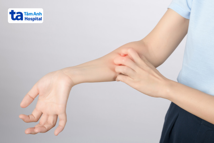 Người phụ nữ gãi tay do ngứa – một tác dụng phụ tiềm ẩn khi dùng empagliflozin