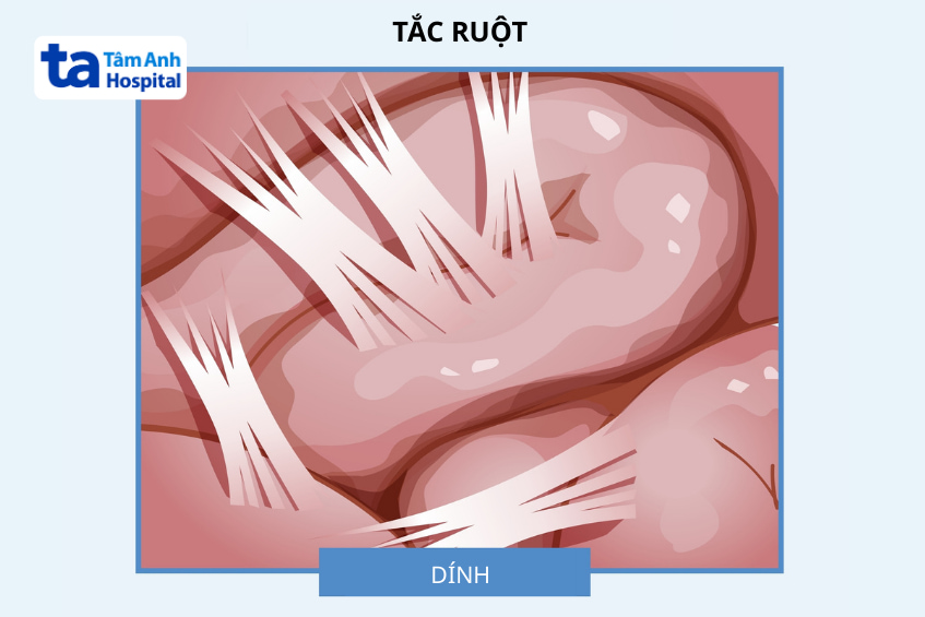 Mô phỏng tình trạng dính ruột gây tắc ruột - biến chứng hiếm gặp sau mổ nội soi túi mật
