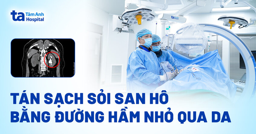 Tán sạch sỏi san hô bằng đường hầm nhỏ qua da