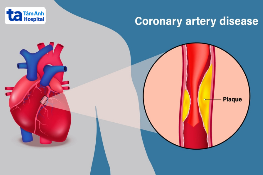 tăng nguy cơ xơ vữa động mạch