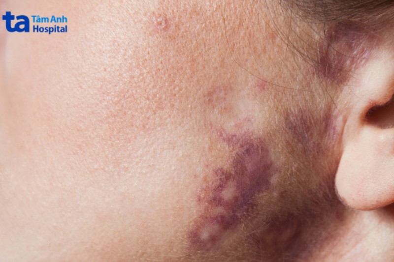 da bị tăng sắc tố sau khi điều trị sẹo