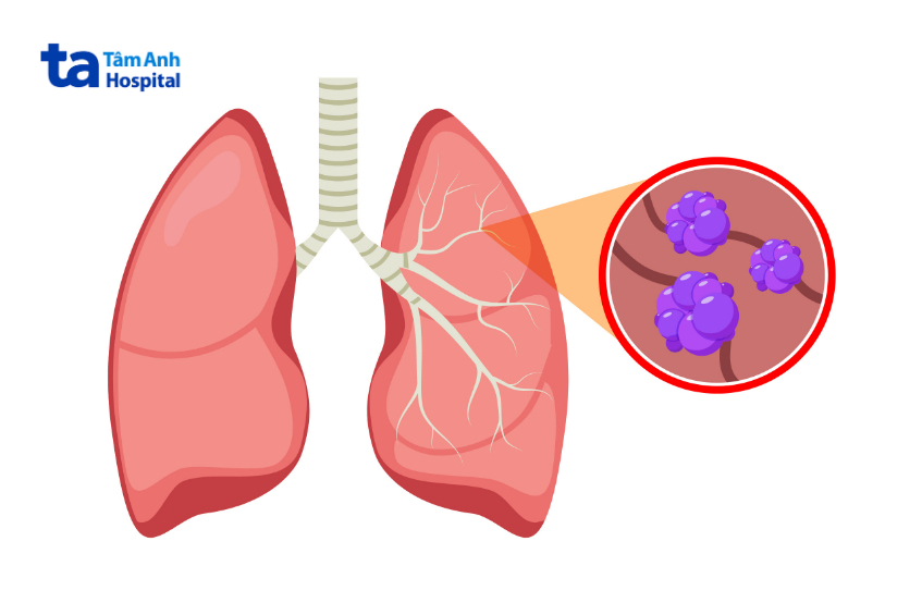 Hình minh họa tế bào ung thư xuất hiện trong mô phổi bên phải