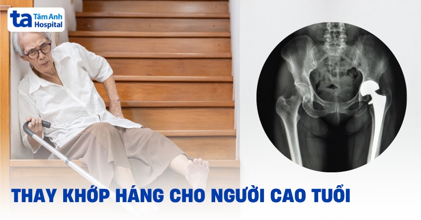 Thay khớp háng cho người cao tuổi có nên lựa chọn?