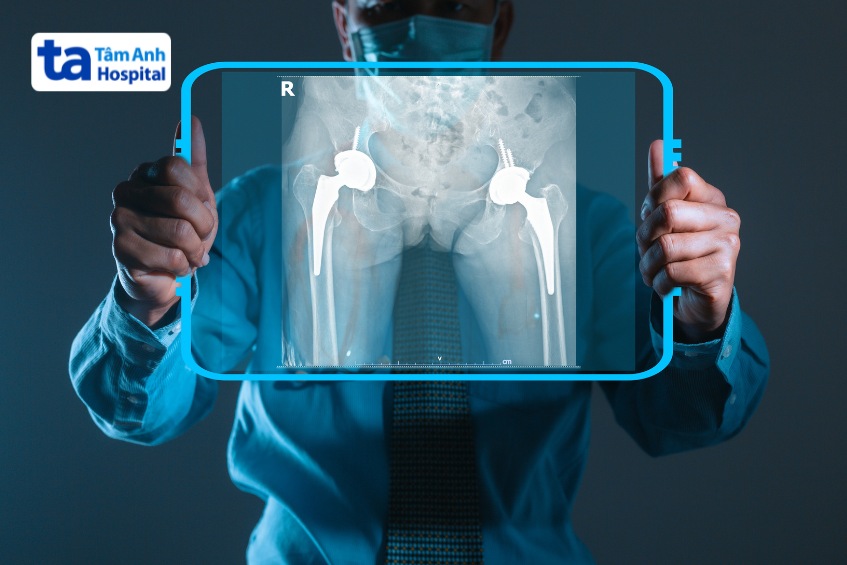 thay khớp háng toàn phần thường được chỉ định trong trường hợp tổn thương khớp háng nặng