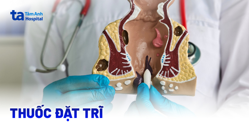 Thuốc đặt trĩ chọn loại nào hiệu quả cao? Cách đặt ra sao?