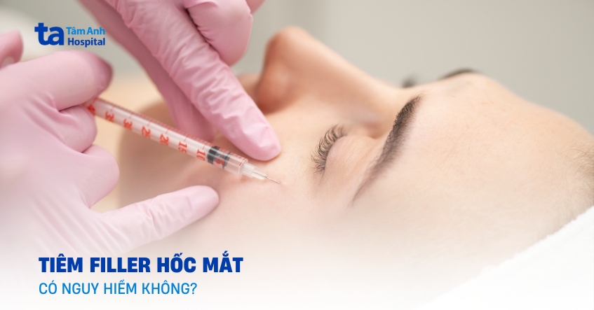 Tiêm filler hốc mắt chống chỉ định với những trường hợp nào?