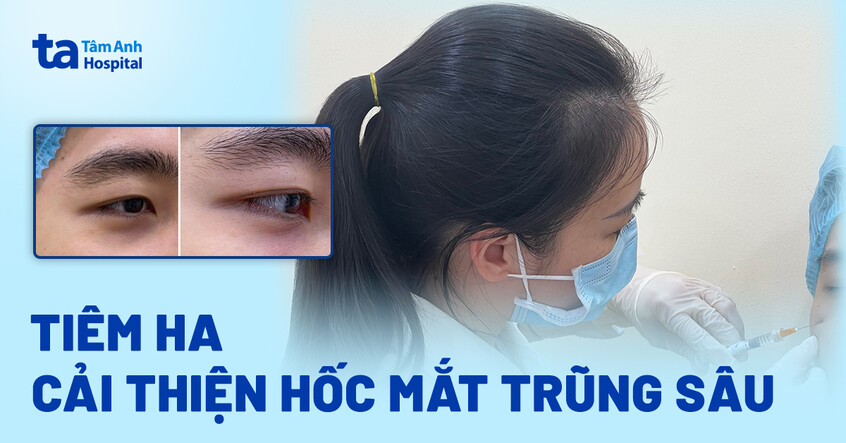 Tiêm HA cải thiện hốc mắt trũng sâu