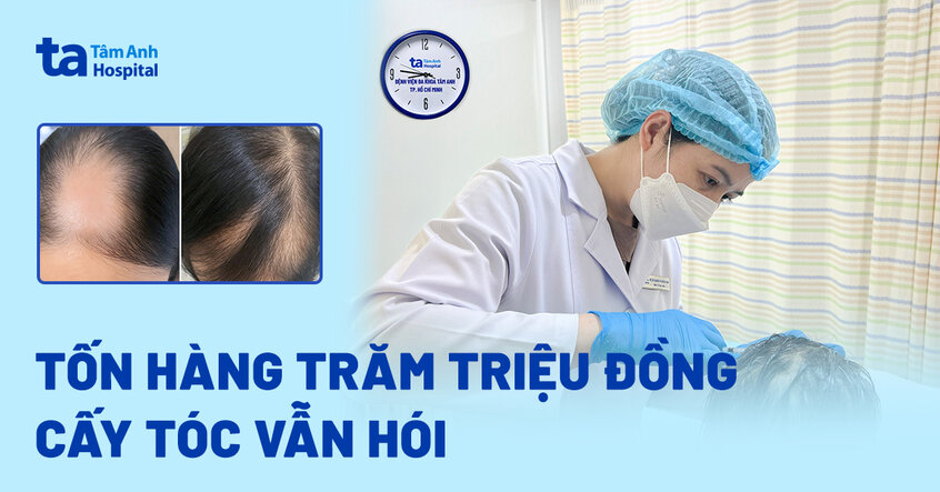 Tốn hàng trăm triệu đồng cấy tóc vẫn hói