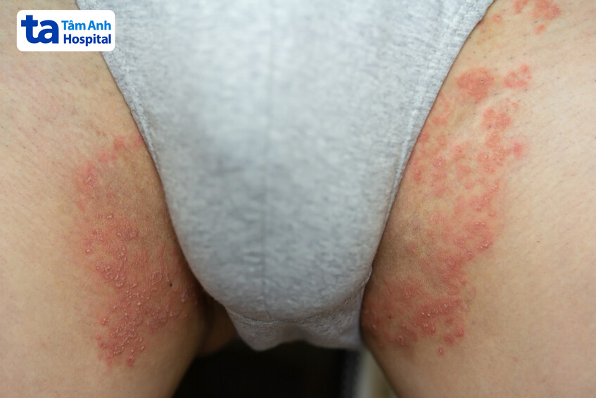 Tổn thương lan rộng từ vùng bìu đến mặt trong đùi