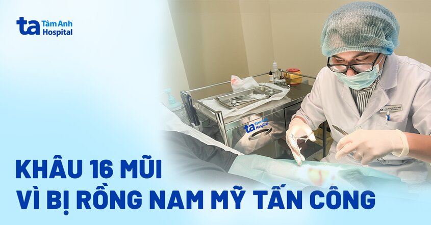 Khâu 16 mũi vì bị rồng Nam Mỹ tấn công