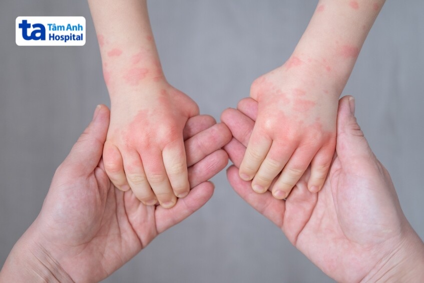 triệu chứng khởi phát