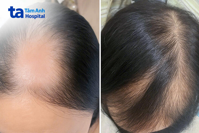 trước và sau khi điều trị tại tâm nah