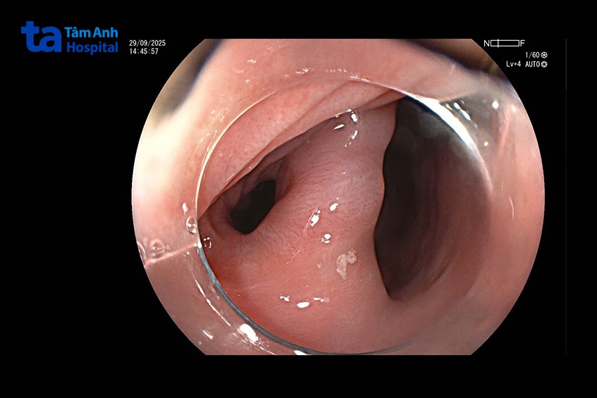 túi thừa thực quản trên ảnh nội soi