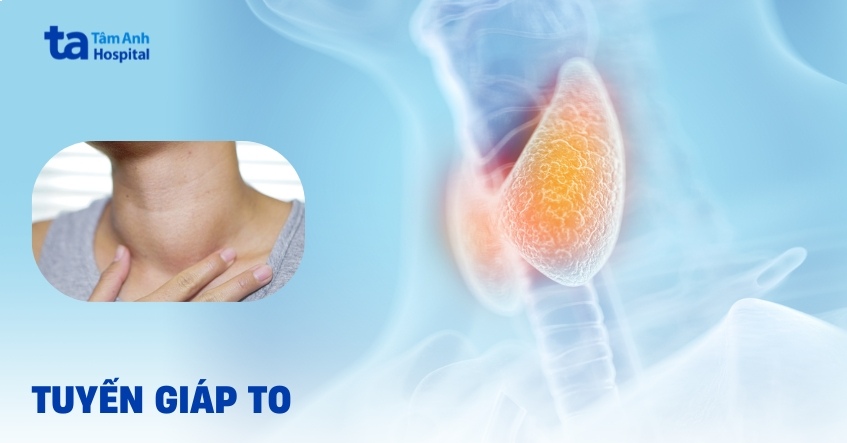 Tuyến giáp to là biểu hiện của các bệnh lý nào?