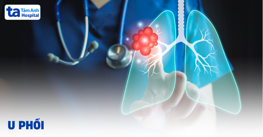 U phổi là gì? Phân biệt u phổi lành tính và ác tính
