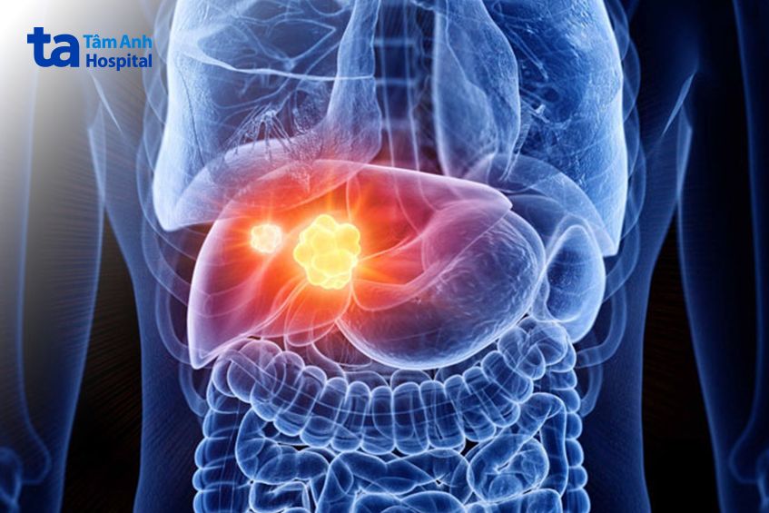 u xâm lấn sâu hơn vào gan