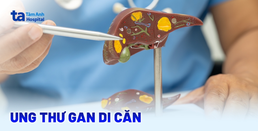 Ung thư gan di căn đi đâu? Cách nhận biết sớm