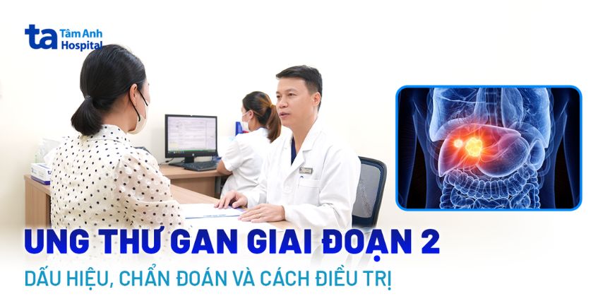 Ung thư gan giai đoạn 2: Dấu hiệu, chẩn đoán và cách điều trị