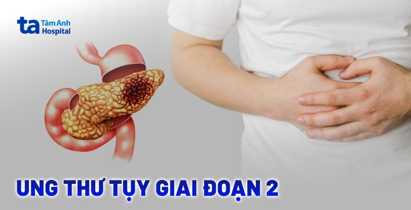 Ung thư tụy giai đoạn 2 sống được bao lâu?