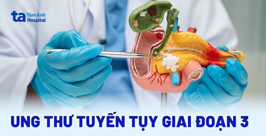 Hiểu rõ ung thư tuyến tụy giai đoạn 3 trước khi điều trị