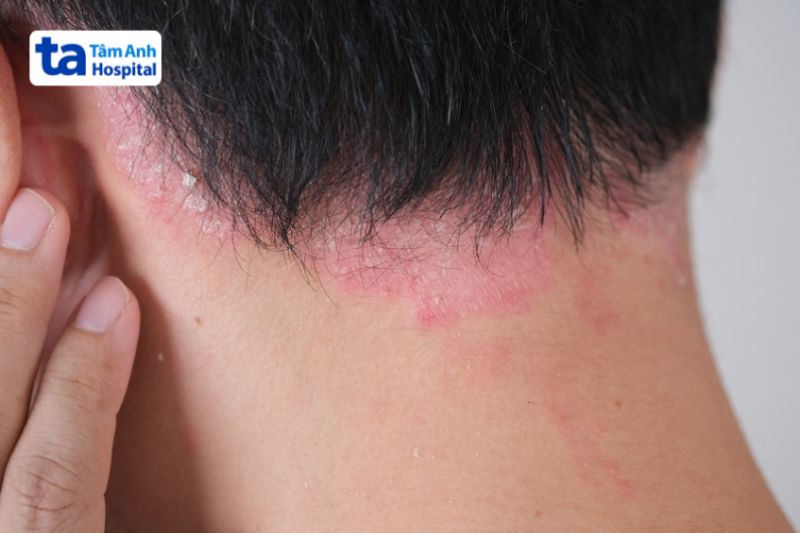 vảy nến đỏ da trên da đầu