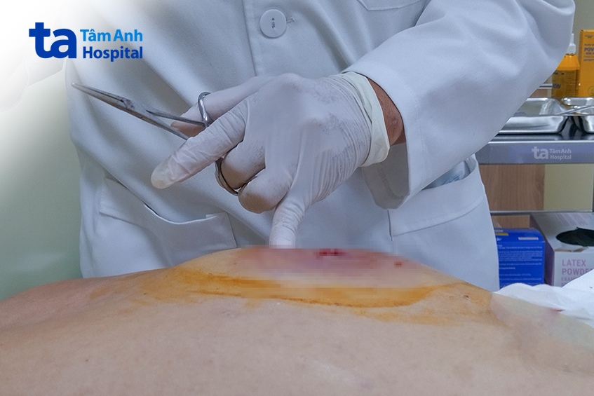 vết thương trên lưng chị lý sưng tấy, nhiễm trùng lan rộng