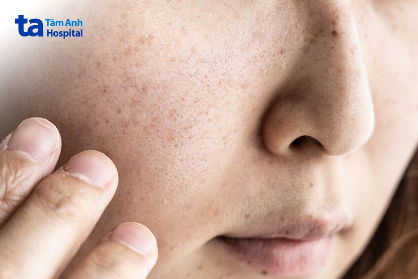 vì sao sau peel da không bị bong tróc