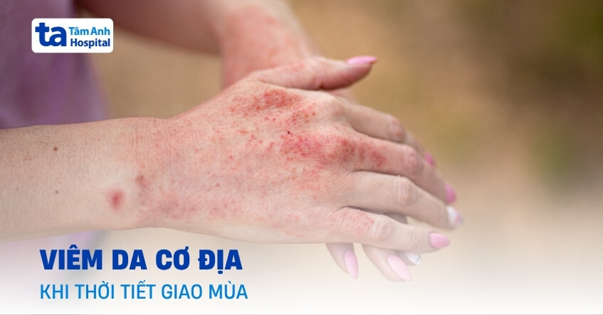 Thận trọng viêm da cơ địa khi giao mùa xảy ra