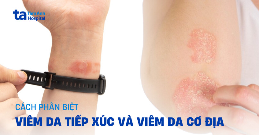 Viêm da tiếp xúc và viêm da cơ địa: Khác hay giống nhau?