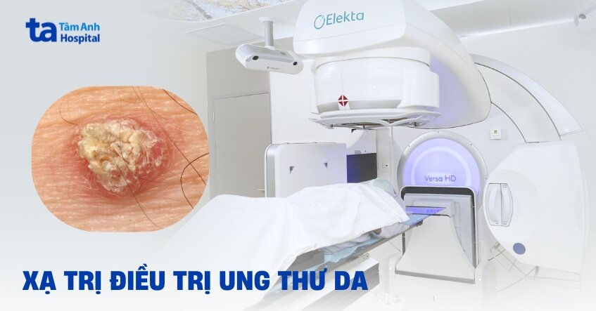 xạ trị điều trị ung thư da