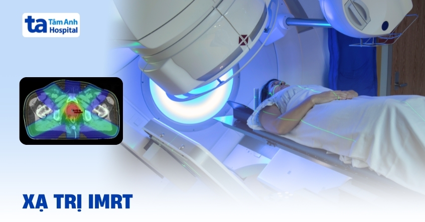 Xạ trị điều biến liều IMRT và những thông tin cần biết