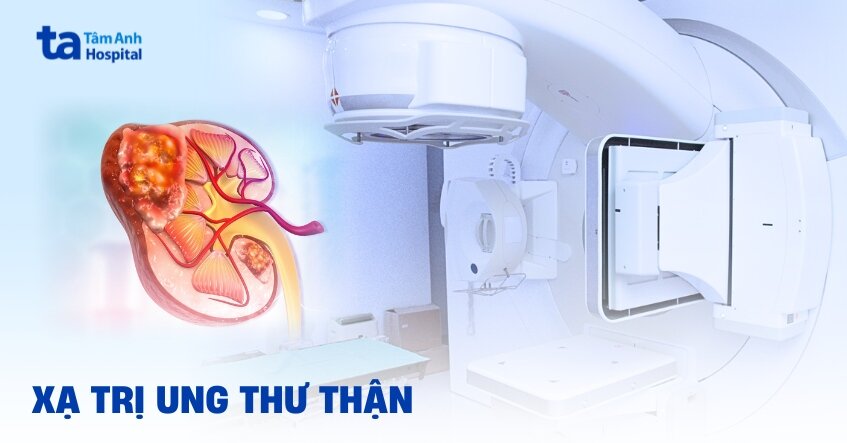 Khi nào nên tiến hành xạ trị ung thư thận?
