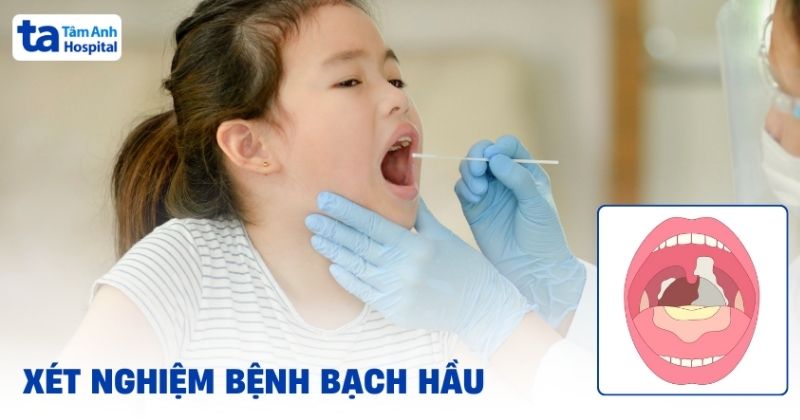 4 xét nghiệm bạch hầu chính xác theo quy trình chuẩn y khoa