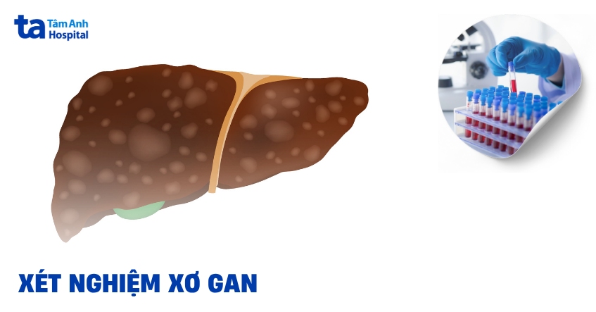 Xét nghiệm xơ gan khi nào cần làm, có cần thiết không?