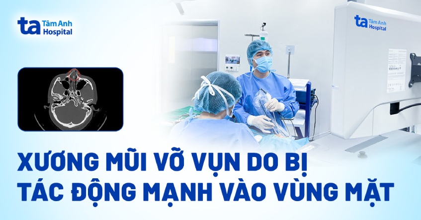 Xương mũi vỡ vụn do bị tác động mạnh vào vùng mặt