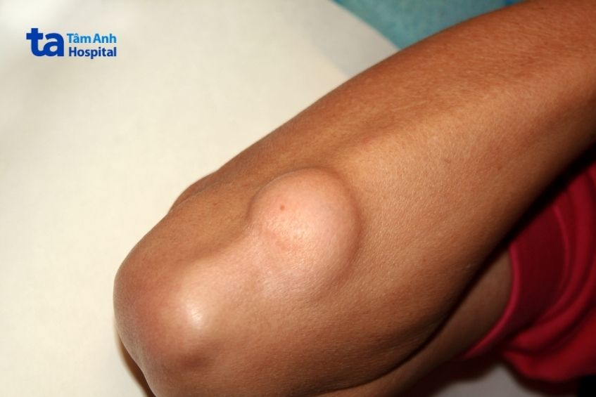 Khối u mỡ to dần gây đau đớn