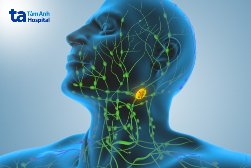 ung thư hạch là bệnh ung thư do tế bào bạch cầu lympho trong hệ thống bạch huyết phát triển không kiểm soát