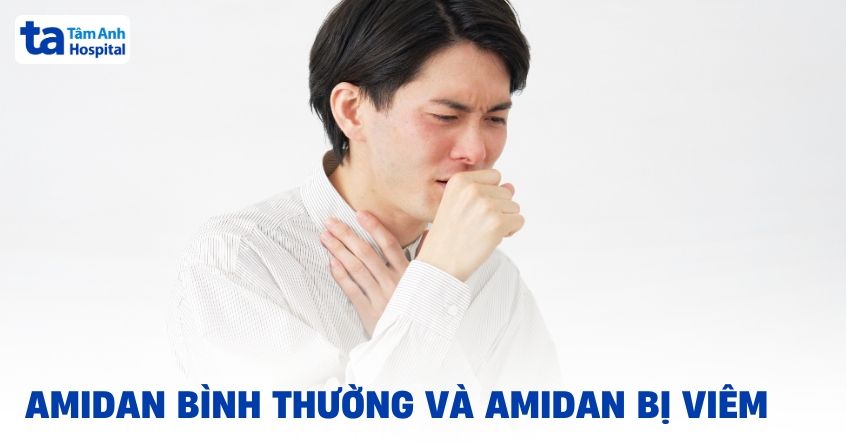 Cách nhận biết amidan bình thường và amidan bị viêm